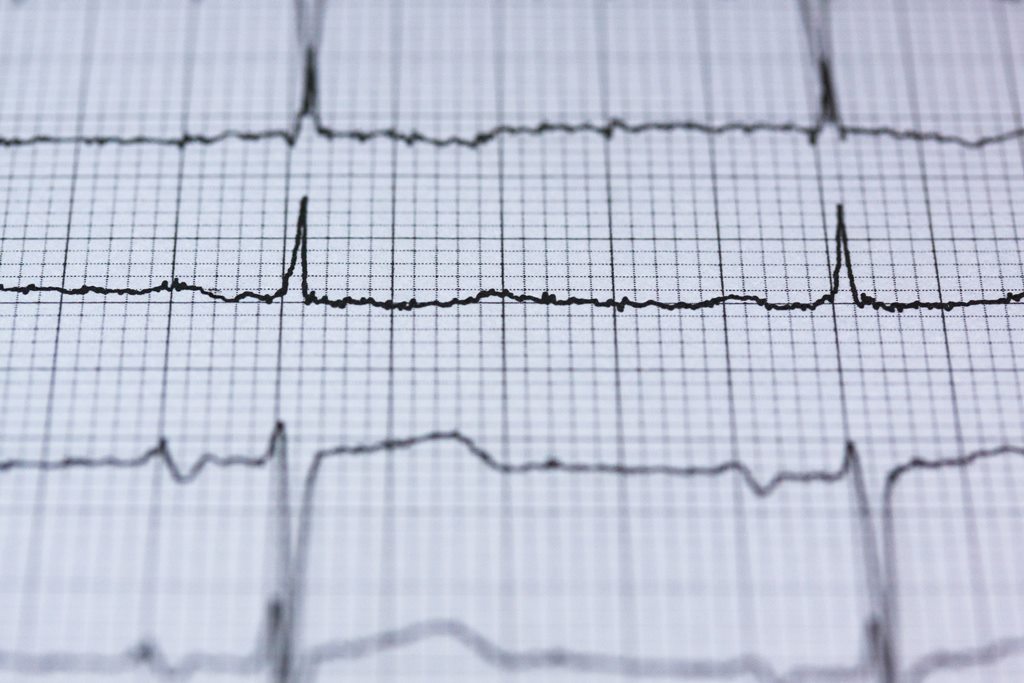 Resultado de eletrocardiograma com traçado demonstrando uma possível fibrilação atrial.